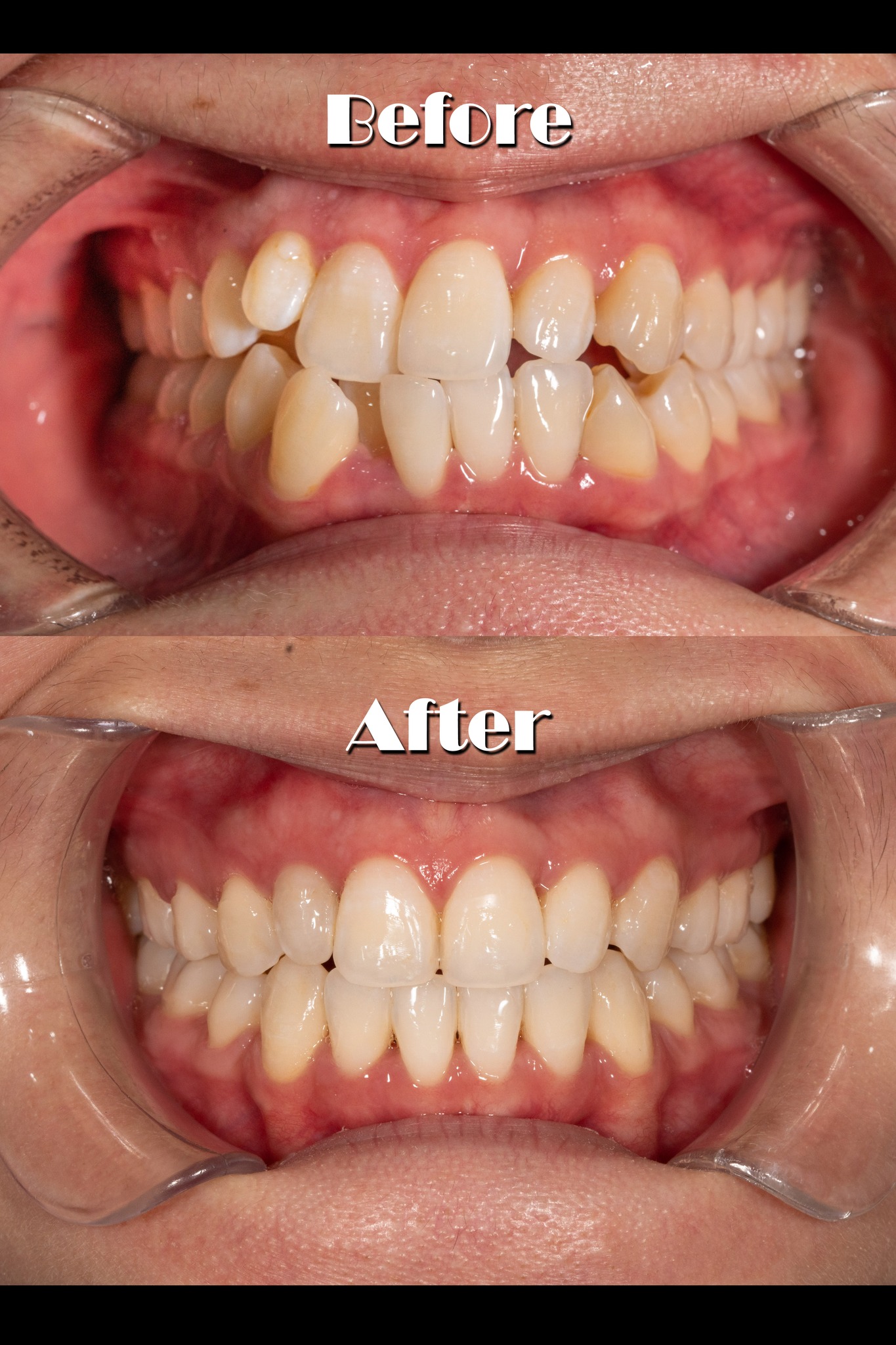 Braces Penang Dental Hub