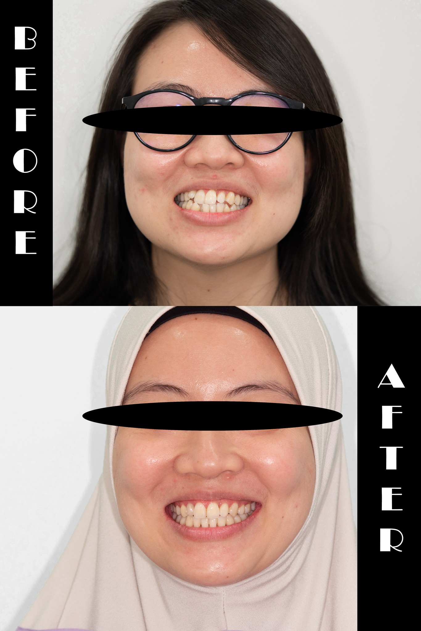 Braces Penang Dental Hub